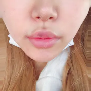 4日目の経過画像（1枚目）