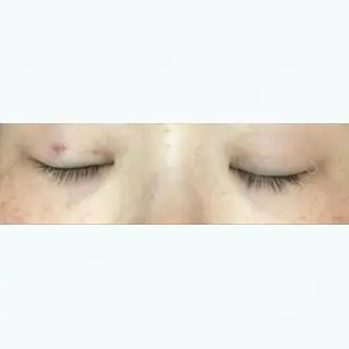 1日目の経過画像（2枚目）