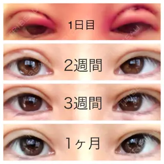 30日目の経過画像（1枚目）