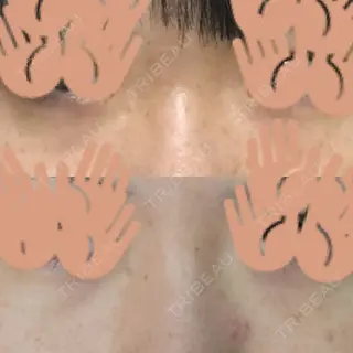 8日目の経過画像（3枚目）
