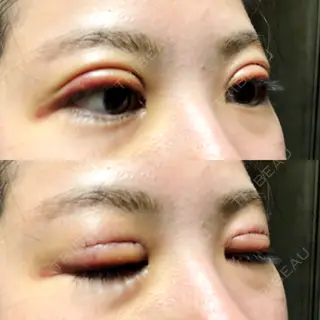 6日目の経過画像（3枚目）