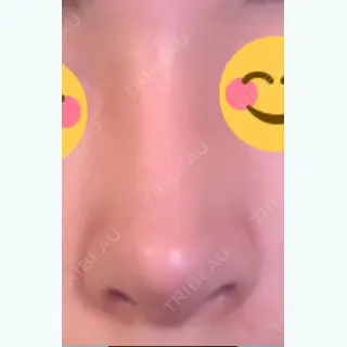 20日目の経過画像（2枚目）