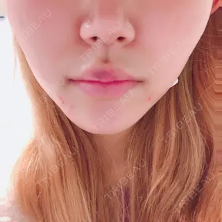 0日目の経過画像（1枚目）