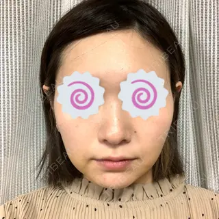 6日目の経過画像（2枚目）