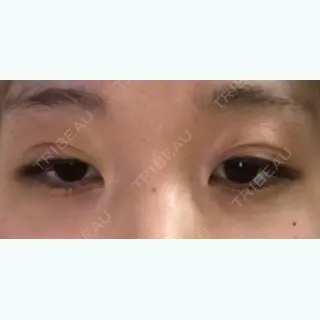 7日目の経過画像（2枚目）