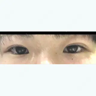 0日目の経過画像（1枚目）