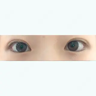 14日目の経過画像（1枚目）