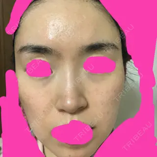 4日目の経過画像（1枚目）