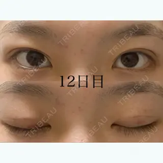 12日目の経過画像（1枚目）