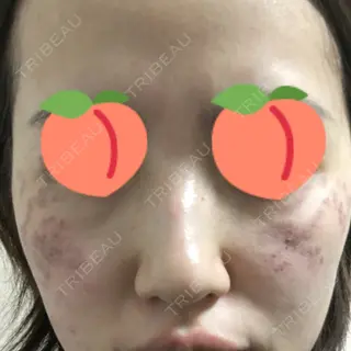 0日目の経過画像（1枚目）