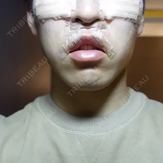 0日目の経過画像（1枚目）