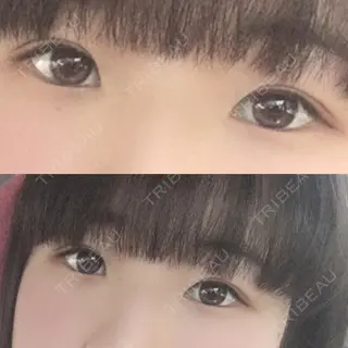 5日目の経過画像（1枚目）