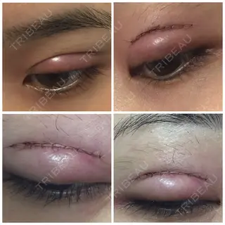 0日目の経過画像（2枚目）