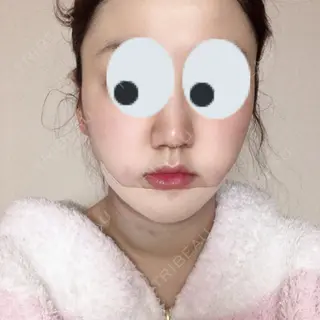 0日目の経過画像（2枚目）