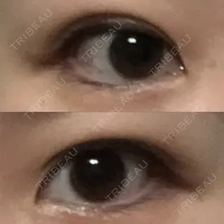 0日目の経過画像（1枚目）
