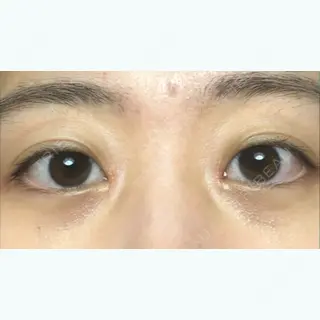 30日目の経過画像（1枚目）