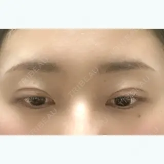 52日目の経過画像（2枚目）