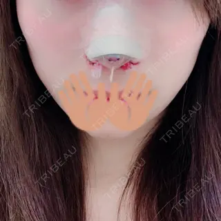 0日目の経過画像（1枚目）