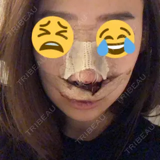 0日目の経過画像（1枚目）