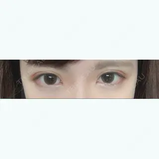 5日目の経過画像（1枚目）
