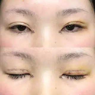 6日目の経過画像（1枚目）