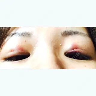 0日目の経過画像（2枚目）