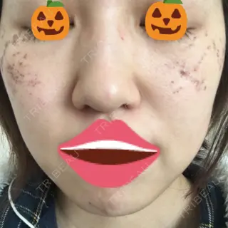 5日目の経過画像（1枚目）