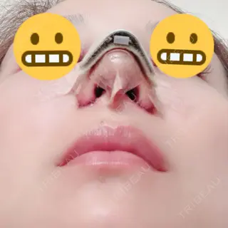 2日目の経過画像（2枚目）