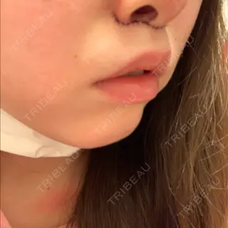 0日目の経過画像（1枚目）