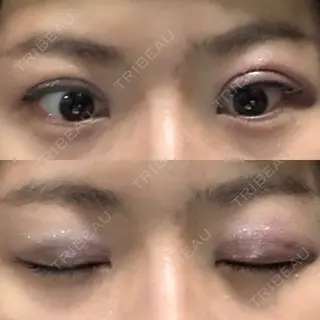 0日目の経過画像（1枚目）