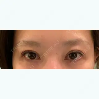 11日目の経過画像（2枚目）