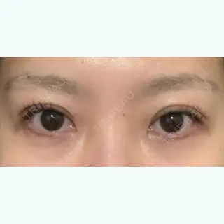 15日目の経過画像（2枚目）