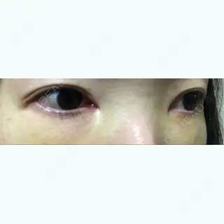 3日目の経過画像（1枚目）