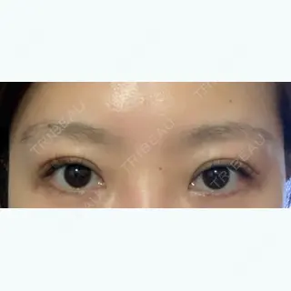 16日目の経過画像（2枚目）