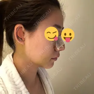 6日目の経過画像（2枚目）