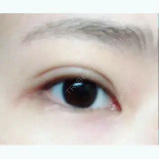 13日目の経過画像（1枚目）