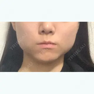 0日目の経過画像（1枚目）