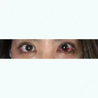 13日目の経過画像（1枚目）