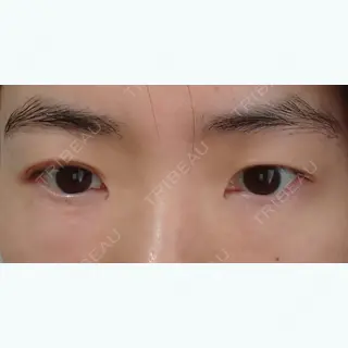 1日目の経過画像（1枚目）