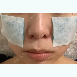 0日目の経過画像（1枚目）