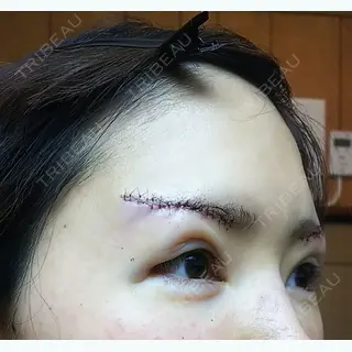 0日目の経過画像（2枚目）