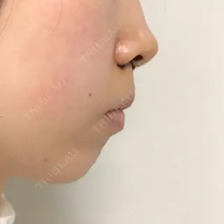 4日目の経過画像（2枚目）