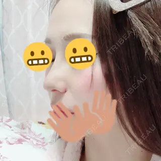 5日目の経過画像（3枚目）