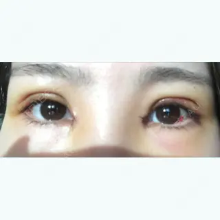 5日目の経過画像（1枚目）