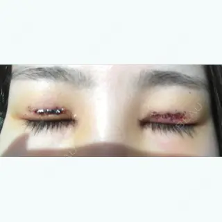 5日目の経過画像（2枚目）
