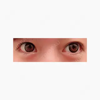 0日目の経過画像（1枚目）