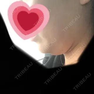 0日目の経過画像（2枚目）