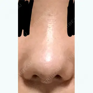 7日目の経過画像（1枚目）