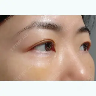5日目の経過画像（3枚目）