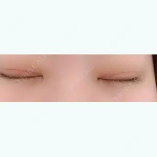 6日目の経過画像（2枚目）